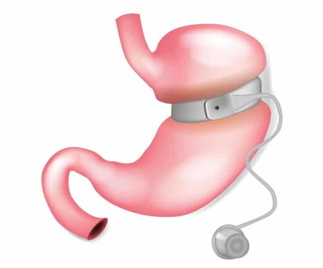 Les opérations de chirurgie bariatrique, anneau gastrique à Paris 17 avec le Dr Servajean