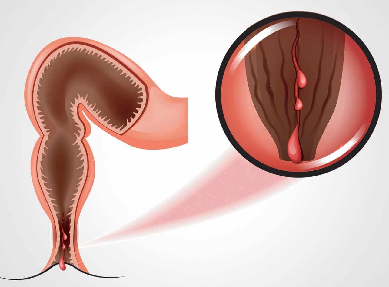 Pathologie des fissures anales à Paris 17 avec le Dr Servajean