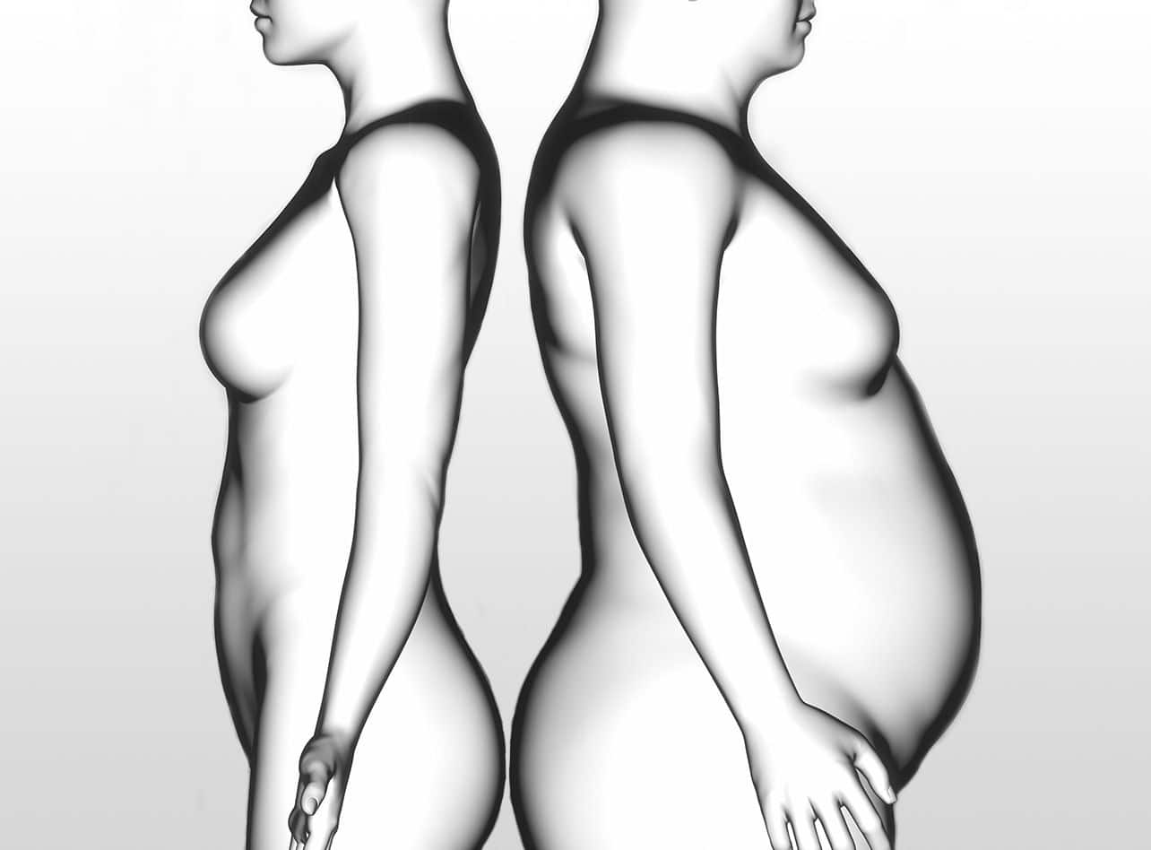 Surpoids et obésité, chirurgie bariatrique à Paris 17 avec le Dr Servajean