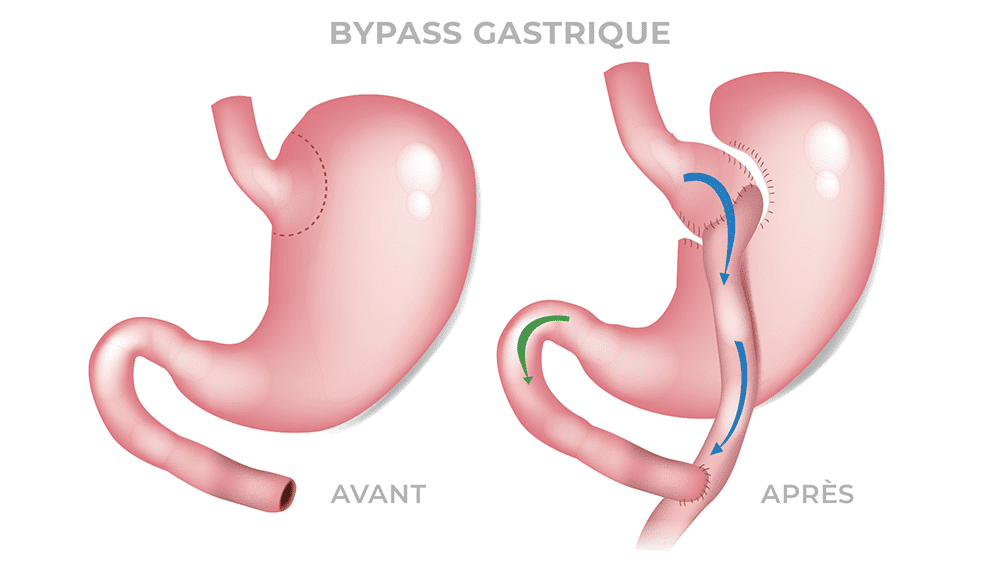 Le bypass gastrique et les causes de la dilatation de l’estomac - expliquées par dr Servajean Paris