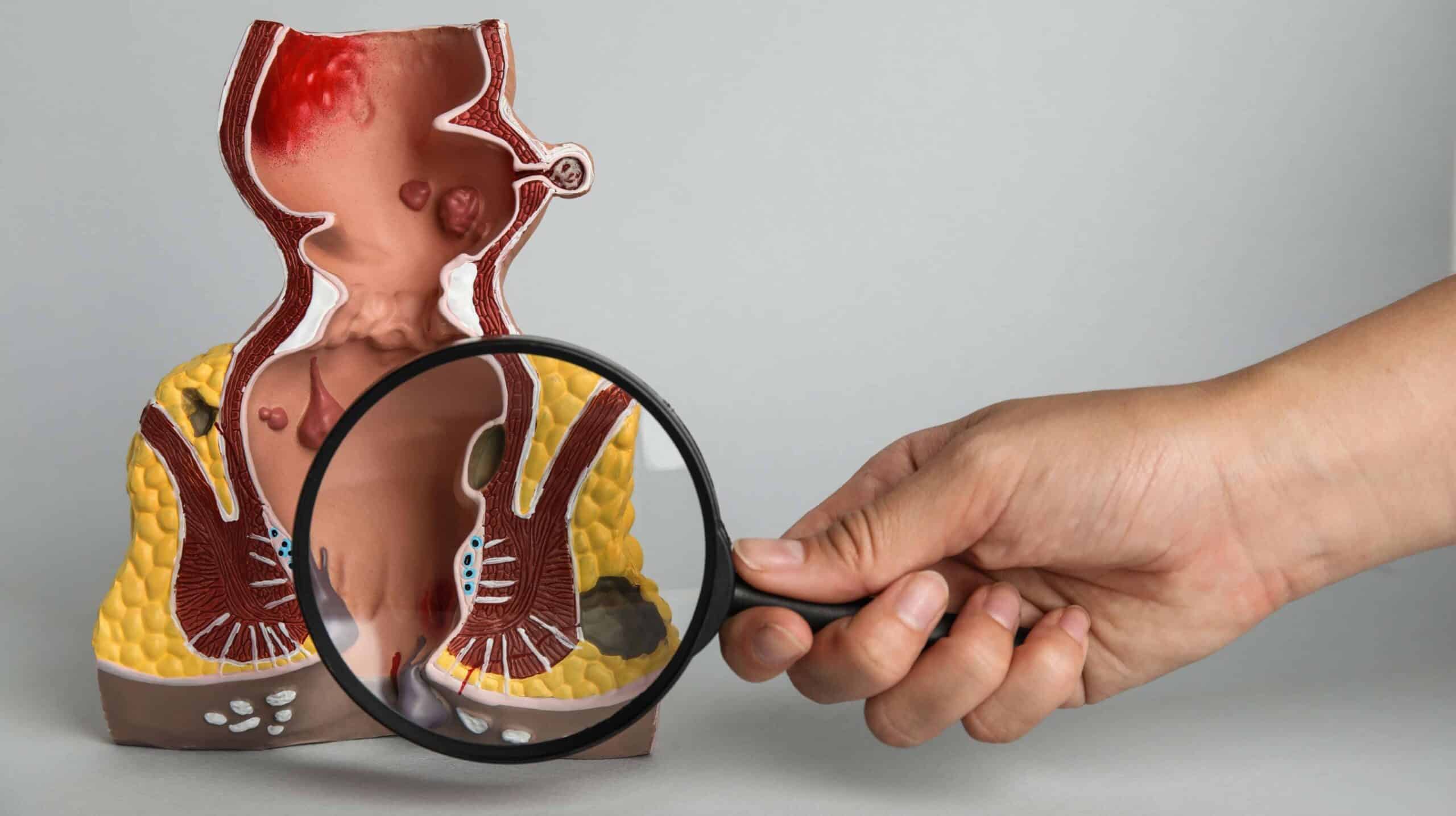 Quelles sont les causes de la fistule anale ? | Dr Servajean | Paris